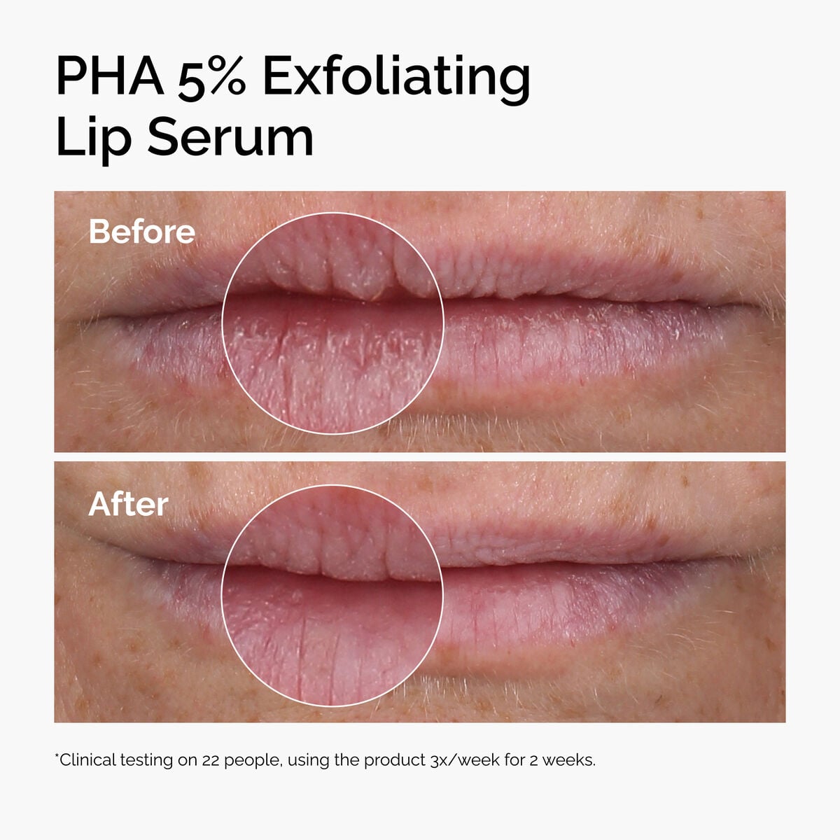 pha-5-exfoliating-lip-serum-m5 ord-pha-5pct-lip-exfoliating-serum-before-after.jpg