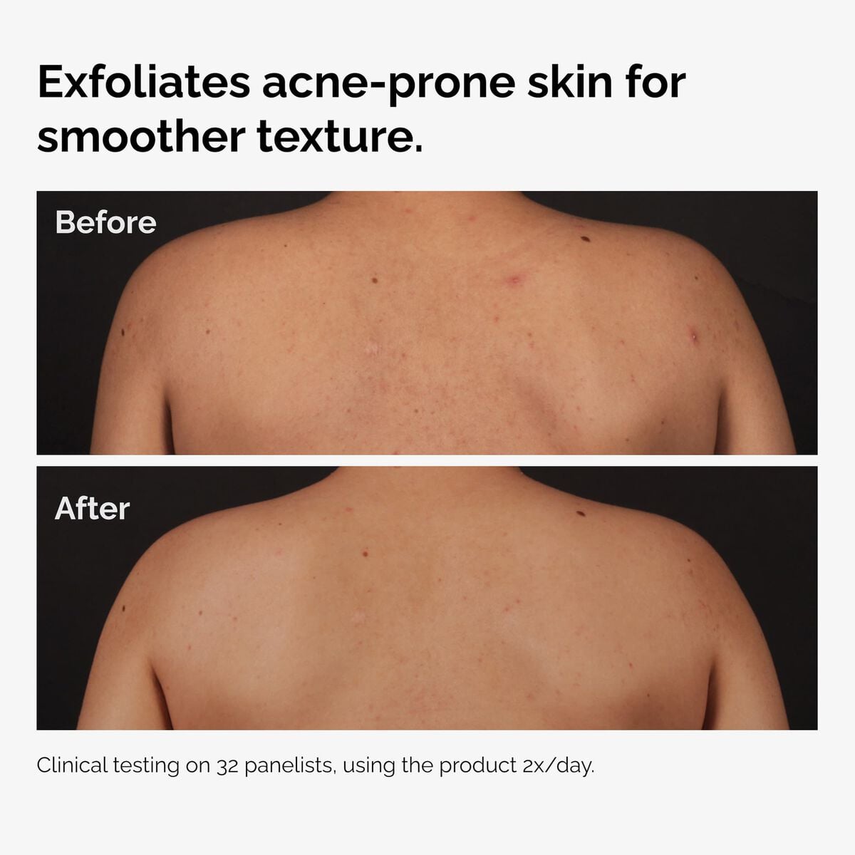 salicylic-acid-0-5-body-serum-g8 ord-salicylic-acid-body-serum-before-after-graphic-NA.jpg