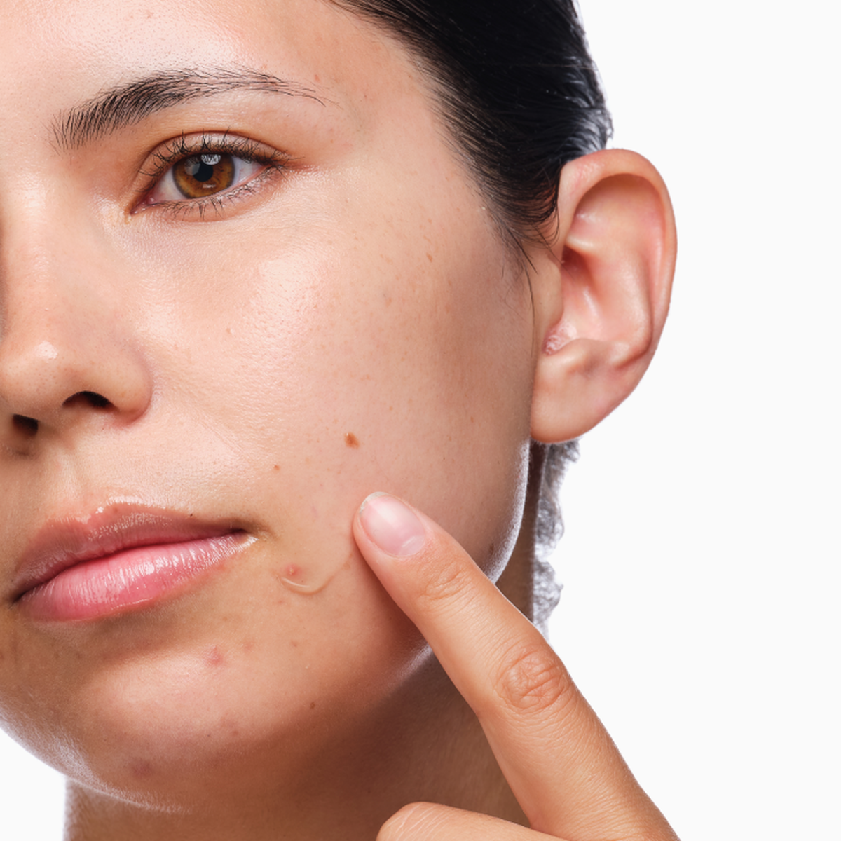 the-acne-set-o7 rdn-the-acne-set-application.png